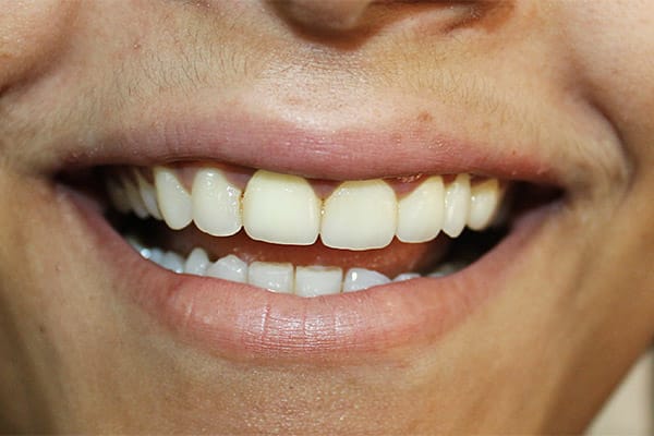 Best Teeth Whitening Treatment in Mumbai & Gum Depigmentation Treatment in Mumbai