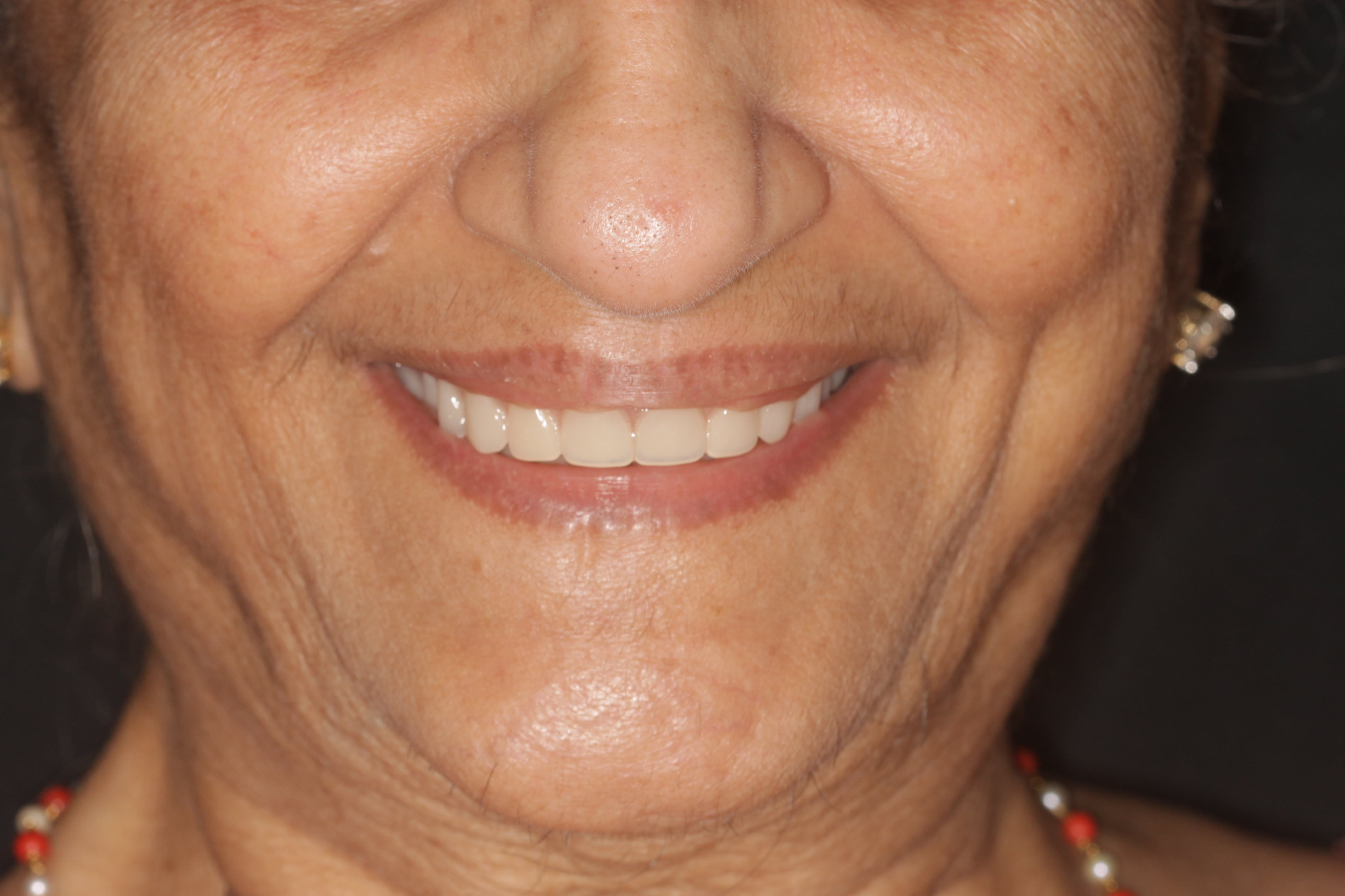 Dental Implants Treatment in Mumbai