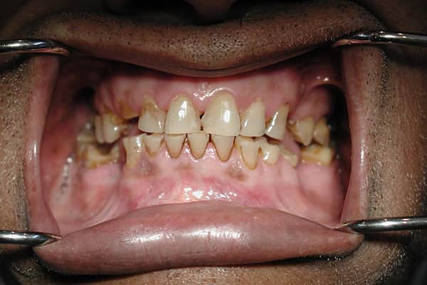 Full Mouth Rehabilitation Treatment in Mumbai